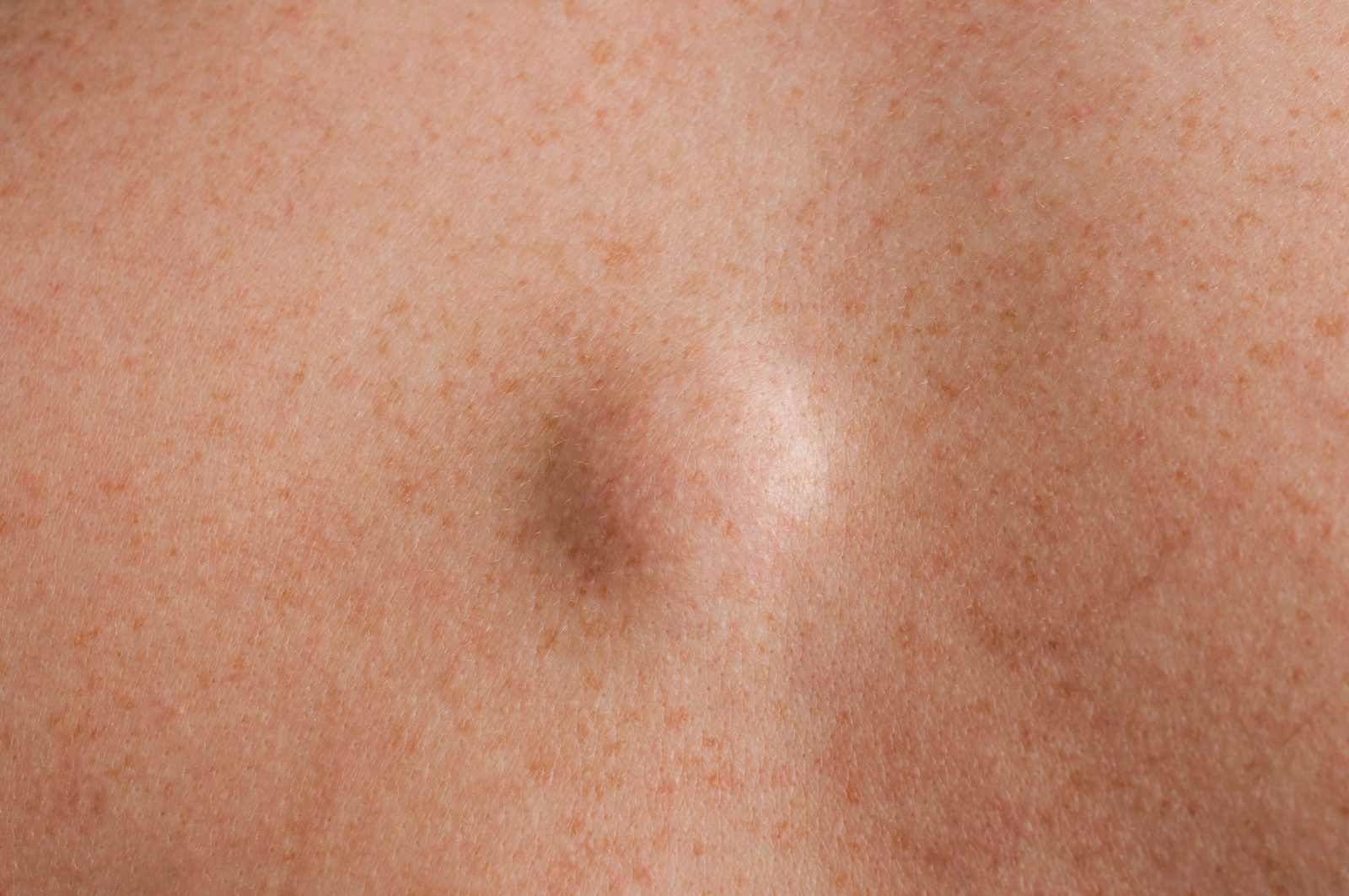 Bild eines Lipoms