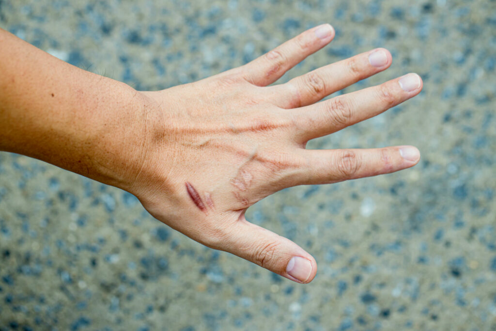 Hypertrophe Narben auf einer Hand